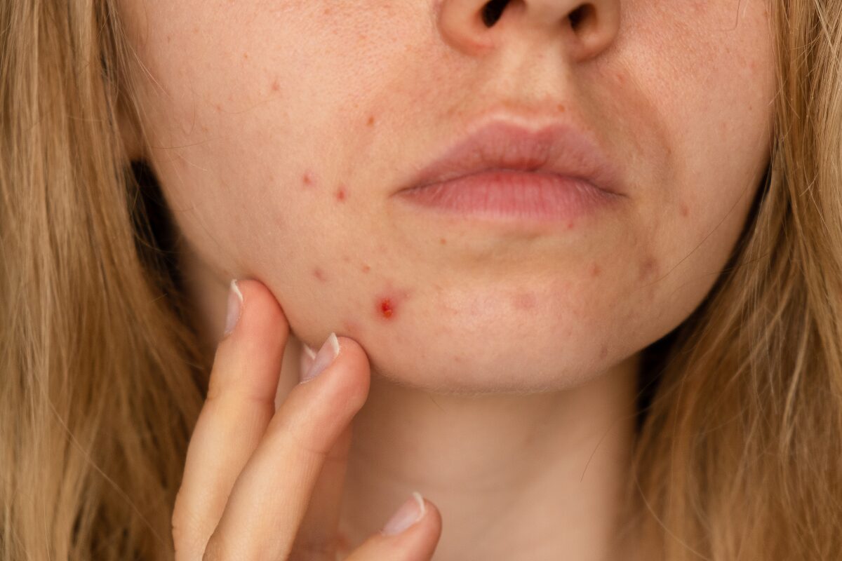 menopausal-acne.jpg